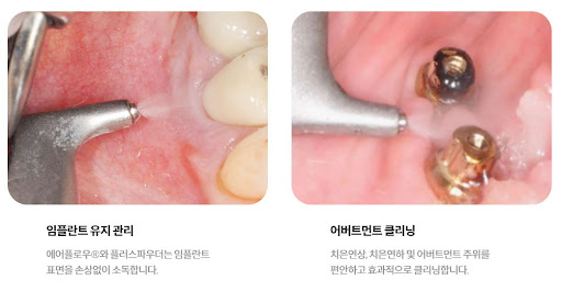 불당본점 서울비디치과의원 - 치아교정과 임플란트 전문 치료